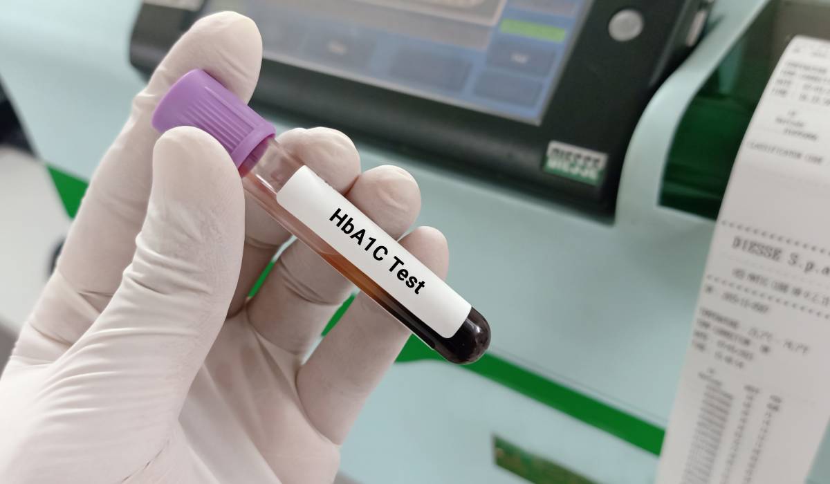 Deficiența de fier poate falsifica rezultatele testului HbA1c pentru diabet