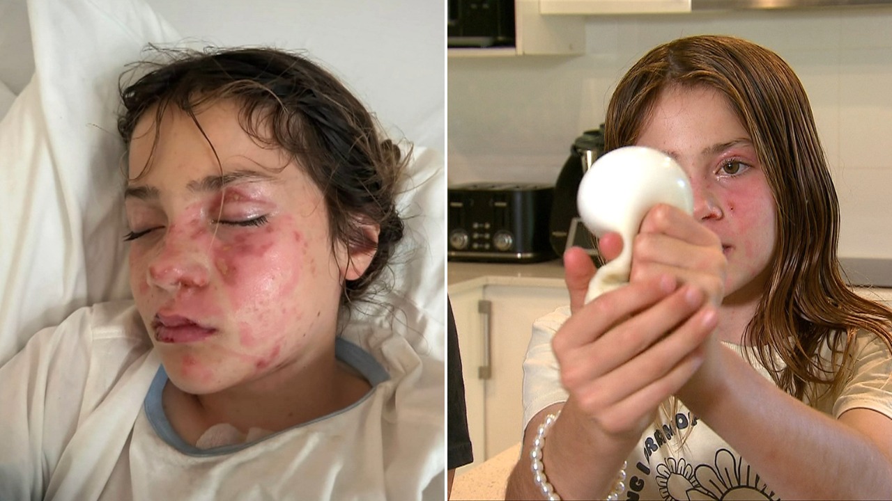 Fetiță de 10 ani, arsă pe față după ce a încălzit o jucărie squishy la microunde, provocare virală pe TikTok