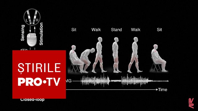 Reprezentare a stimulării cerebrale profunde asistată de inteligență artificială pentru boala Parkinson