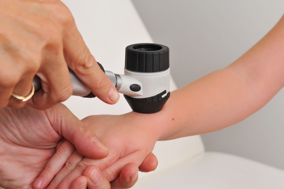 O aluniță suspectă pe piele, cu contur neregulat și culori variate, examinată de un dermatolog cu un dermatoscop.