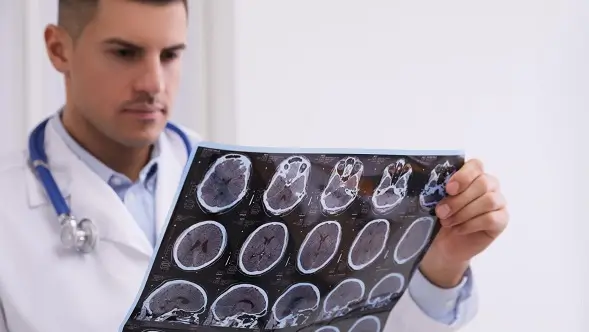 Scleroza multiplă primar progresivă: ocrelizumab reduce progresia dizabilității, arată un studiu clinic