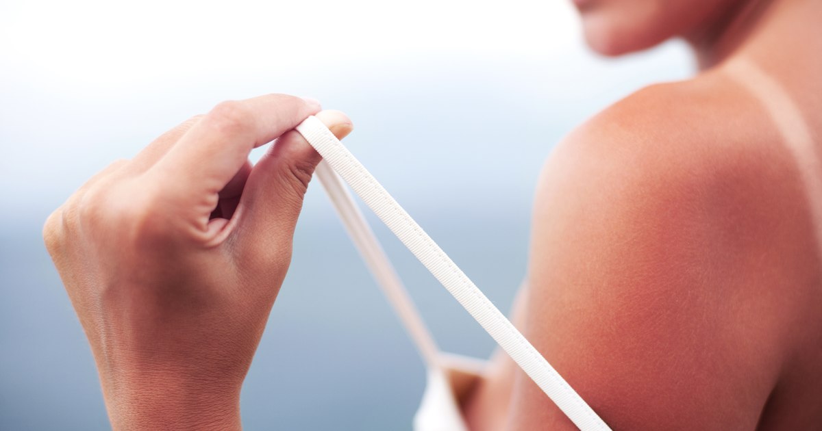Cinci arsuri solare pot dubla riscul de melanom, avertizează dermatologii